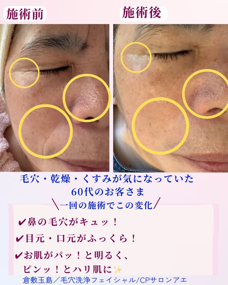 毛穴・乾燥・くすみが気になっていた60代のお客さま 施術前と施術後