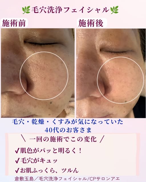 毛穴・乾燥・くすみが気になっていた40代のお客さま 施術前と施術後