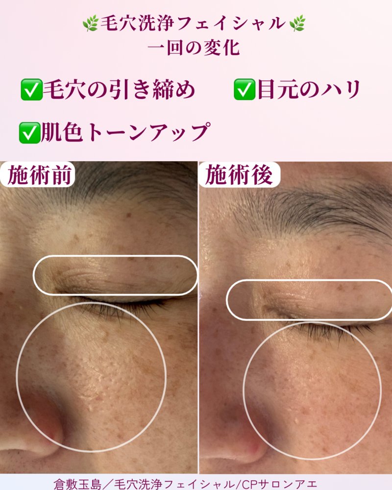 毛穴洗浄フェイシャル 一回の変化