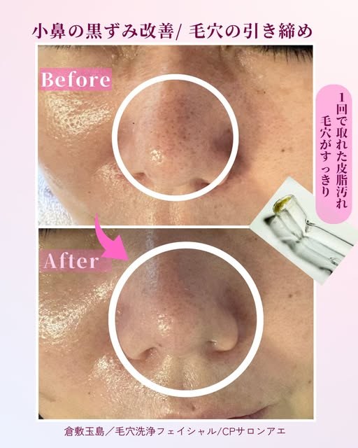 小鼻の黒ずみ・毛穴 施術前と施術後