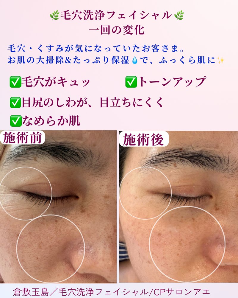 毛穴・目元の小じわが気になる30代のお客さま 施術前と施術後