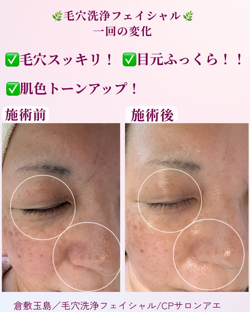 毛穴洗浄フェイシャル 施術前と施術後